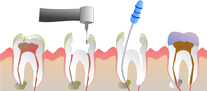 endodontia-tratament-de-canal-sua-odontologia-dentista-tucuruvi