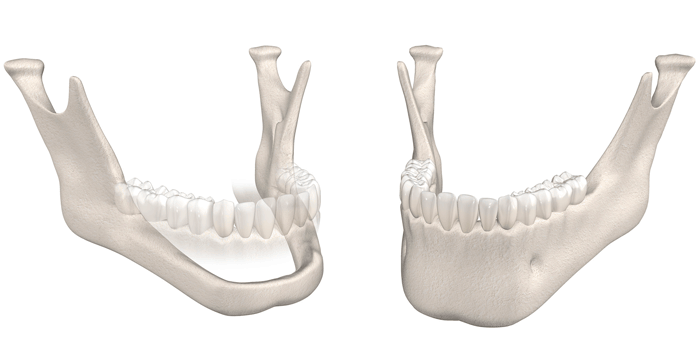perda-ossea-mandibular