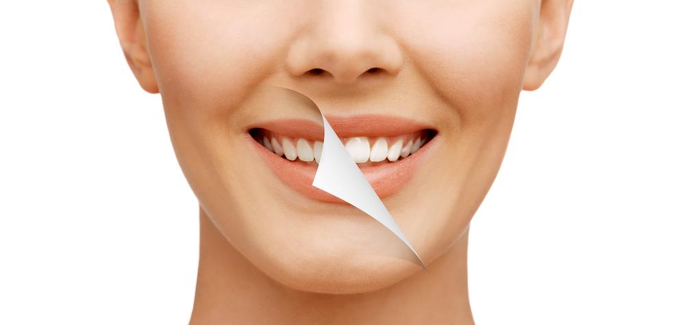 Lente de contato dental. Informações essenciais.